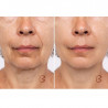 Beautifly B-Glossy Blush μη επεμβατική συσκευή μεσοθεραπείας, Διέγερση του κυτταρικού μεταβολισμού, Φωτοθεραπεία και ιονοθεραπεία, Μειώνει τις ρυτίδες και τα σημάδια ακμής, Ροζ