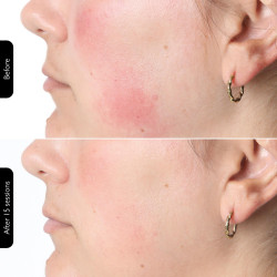 Φωτοθεραπευτική μάσκα προσώπου Silk'n LED Face Mask 100 FLM100PE1001, Αυτονομία 130 λεπτών, 4 λειτουργίες, Συνεδρία 10 λεπτών, Ευέλικτος σχεδιασμός, Λευκό